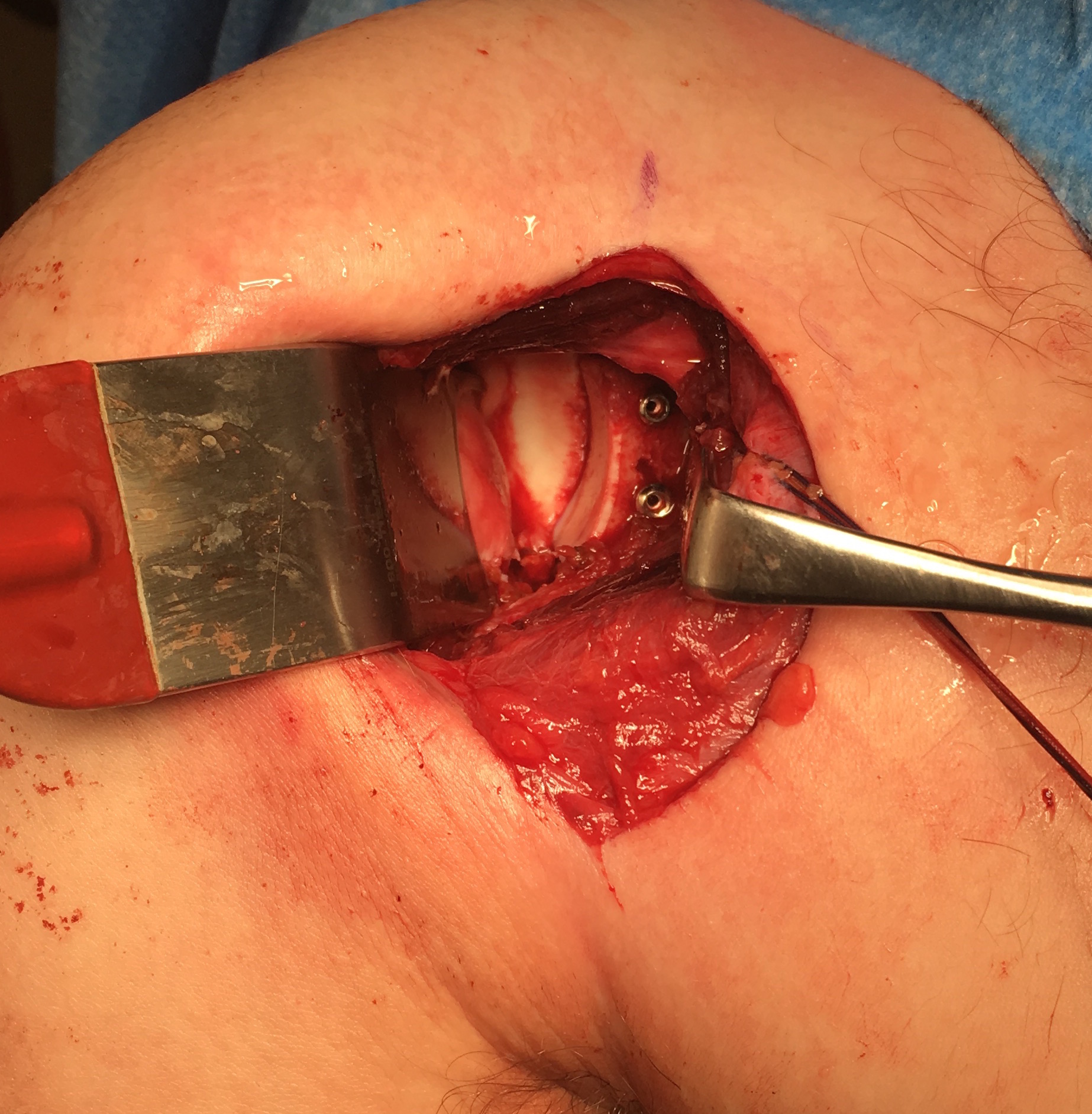 Distal Tibial Allograft 3